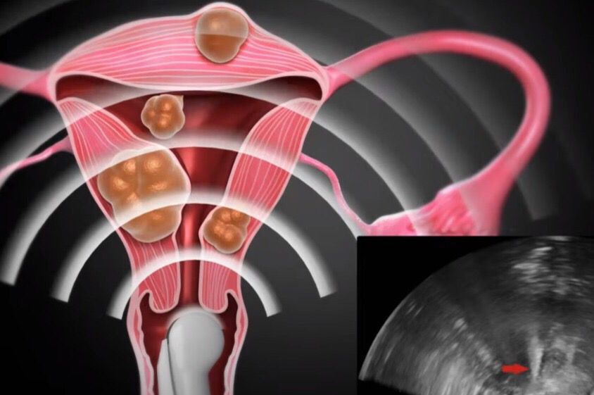 Câncer de mama: ablação ovariana